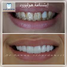 To make dental knowledge more accessible, we developed better smile, a portable dental assistant for everyone! Ultra Dental Center On Twitter Better Teeth Better Smile Hollywood Smile Dr Rawan Elbardaweel Ultra Dental Center Ù‡ÙˆÙ„ÙŠÙˆÙˆØ¯ Ø³Ù…Ø§ÙŠÙ„ Ø§Ù„Ø¯ÙƒØªÙˆØ±Ø© Ø±ÙˆØ§Ù† Ø§Ù„Ø¨Ø±Ø¯ÙˆÙŠÙ„ Ù„Ø­Ø¬Ø² Ø§Ù„Ù…ÙˆØ§Ø¹ÙŠØ¯ ÙˆØ§Ù„Ø§Ø³ØªÙØ³Ø§Ø± 44410166 44410177 Ultra Dental Center Ø§Ø¨ØªØ³Ø§Ù…Ø©Ù‡ÙˆÙ„ÙŠÙˆÙˆØ¯Ù‚Ø·Ø±