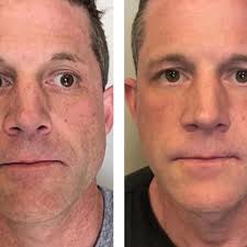 NeoGen™ Evo Skin Regeneration • Skin Regeneration treatment in Cardiff