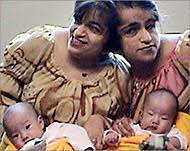 They were joined at the head and died immediately after their complicated. Double Joy As Korean Twins Separated News Al Jazeera