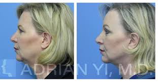 Profile for Adrian Yi, M.D. Plastic Surgery