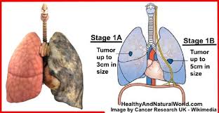 Symptoms of lung cancer develop as the condition progresses and there are usually no signs or symptoms in the early stages. Lung Cancer Know The Early Sign And Symptoms Latest News Diseases Remedies Health Cancer Symptoms And Treatment Symptoms Lung Cancer