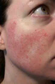 Still, the neutrogena light therapy acne mask isn't. Day 1 Led Red Light Therapy For Rosacea Rosacea Symptoms Acne Rosacea Rosacea Bumps