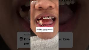 Check spelling or type a new query. Gigi Palsu Bisa Tidak Menggunakan Behel Youtube