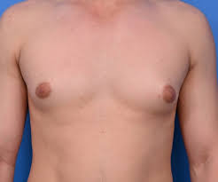 Why Does My Gynecomastia Look Better When It's Cold? | AGC