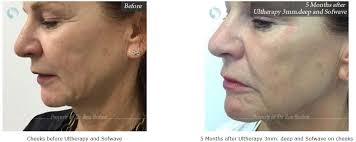 NY Ultherapy Therapy: Facial Skin Tightening NY | Ultherapy NYC