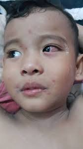 Fakta perubatan & pantang larang. Suria Amanda Aidan Di Serang Chicken Pox