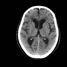 It is estimated to affect at least 1 in 500,000 individuals per year, and some studies suggest an incidence rate of 5.9 cases per 100,000 live births. Herpes Simplex Virus Hsv Encephalitis Radiology Case Radiopaedia Org