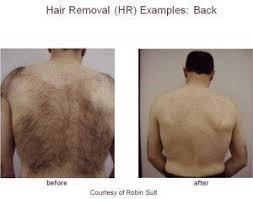 Olive plus, the 810nm pulse diode laser, destroys the black melanin pigments in the hair follicle to remove hair easily. Border Medical Laser Aesthetics Wodonga Vic Laser Hair Removal