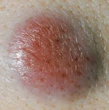 Abnormal cells grow and can form tumors. 7 Skin Cancer Symptoms Besides New Moles Signs Of Skin Cancer