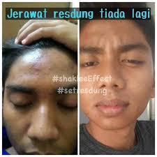 Kecacatan atau ketumbuhan di dalam hidung. 10 Punca Resdung Yang Perlu Anda Ketahui Shidarahmat