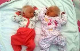 Rare 'Albino Twins' Born With Gorgeous Snow-White Hair - Jesus Daily