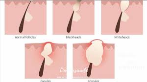 We did not find results for: Cara Menghilangkan Jerawat Alami Dan Cepat Untuk Pria Wanita