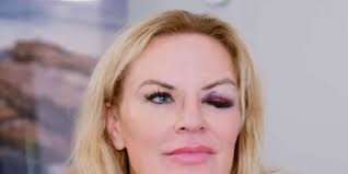 RHOSLC's Heather Gay Shares New Insight About Her Black Eye