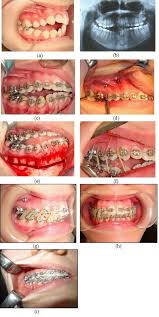The smaller ones aren't too bad, they wear down pretty quickly to a shape that is easier to eat with. Corticotomy And Miniplate Anchorage For Treating Severe Anterior Open Bite Current Clinical Applications Intechopen
