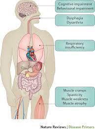 Amyotrophic Lateral Sclerosis Nature Reviews Disease Primers