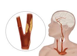 Image result for carotid artery
