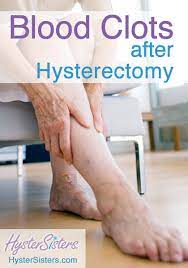 Blood Clots Deep Vein Thrombosis Dvt After Hysterectomy Hysterectomy Recovery Article Hystersisters
