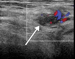This is also known as the medial compartment of the thigh that consists of the adductor muscles of the hip. Us Of The Inguinal Canal Comprehensive Review Of Pathologic Processes With Ct And Mr Imaging Correlation Radiographics