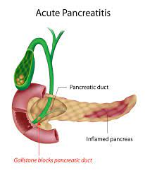 Pancreatitis is generally acute or chronic. Pancreas Pancreatite Pancreatite Cronica Pancreatite Acuta Sintomi Pancreatiti Cura Terapia Diagnosi