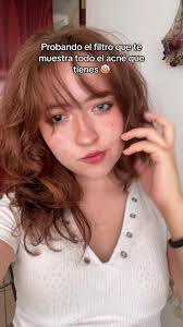 Mi estrés atacandome 🤡 #fyp #acne #acneskin #filtro #trend
