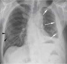 Plaques do not typically cause symptoms and may or may not develop into malignant pleural mesothelioma. Malignant Pleural Mesothelioma With Pleural Plaques A Case Report Semantic Scholar