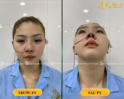 Cắt Cánh Mũi và những thông tin liên quan không thể bỏ qua