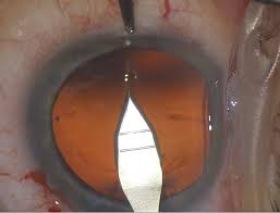 Image result for Cataract Extraction