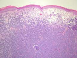 When these cells undergo malignant transformation, merkel cell carcinomas can arise. Merkel Cell Carcinoma Pathology Dermnet Nz