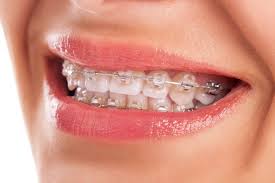Image result for dental braces