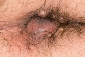Image result for itchy skin rectum