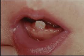Image result for Neonatal Teeth