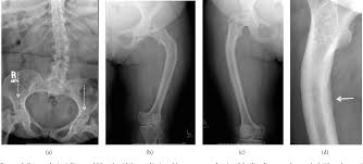 Pdf Imaging Findings And Evaluation Of Metabolic Bone Disease Semantic Scholar