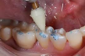 Image result for Occlusal