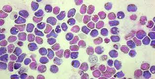 Patients with severe falciparum malaria may develop liver and kidney failure, convulsions, and coma. How Malaria Parasites Reproduce New Insights Embl S European Bionformatics Institute