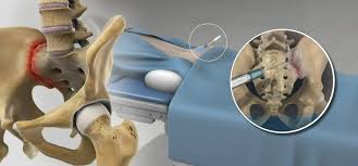 Image result for Joint Injection