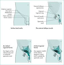 Groin strain treatment rehabilitation exercises although there is often swelling oedema as a result of a groin strain this is often not visible to the eye groin strains are graded 1 2 or 3 depending on the extent of the injury groin muscle diagram diagram muscles in groin area male groin muscle diagram. Lumps In The Groin And Hernia Abdominal Key