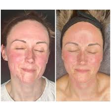 ✨ 6 Weeks. Real Results. ✨ Just 6 weeks of consistent skincare, barrier  repair, and targeted Glow Facials — and the difference speaks for itself!  💆‍♀️🌿 Powered by our signature Fab Skincare