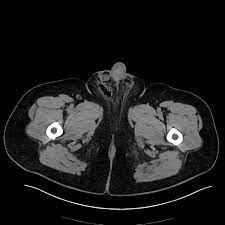 Our second objective was to. Fournier Gangrene Radiology Case Radiopaedia Org