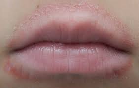 Maybe you would like to learn more about one of these? Mundrose Periorale Dermatitis Ursachen Therapie Derma Plus