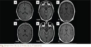 It is the most common cause of rapidly progressive flaccid paralysis. Scielo Brasil Reversible Focal Encephalic Abnormalities In A Patient With Guillain Barre Syndrome Reversible Focal Encephalic Abnormalities In A Patient With Guillain Barre Syndrome