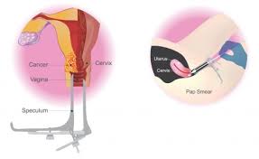 A pap smear can also detect changes in your cervical cells that but if your hysterectomy was for a precancerous or cancerous condition of the cervix, your doctor may recommend continuing routine pap testing. Pap Smear And Hpv Dna Astra Laparoscopic Robotic Centre For Women And Fertility