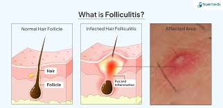 Image result for folliculitis symptoms