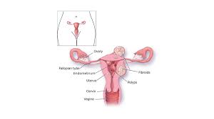 Image result for Menstrual Bleeding