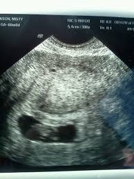 Ultrasound At 8 Weeks