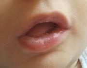 Weisse Flecken Im Mund Ist Das Baby Soor