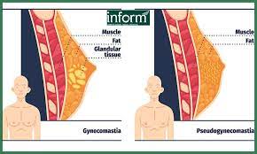 Is my doctor likely to prescribe if i go and get checked for gyno, or is that something people order online? How To Know If You Have Gynecomastia Or Fat Inform Clinics