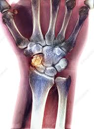 Image result for Wrist XRay