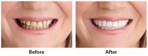 We follow directions when we use a recipe, carry out the responsibilities of a job, build something, pay our bills, drive to a new location, and so on. Get Snap On Smile At Perfect Smiles Stl In Creve Coeur Mo