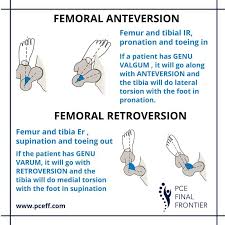 Image result for Femoral Retroversion