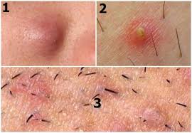 A cyst is a large bump that extends from the skin's surface and deep underneath it. Pin On Beauty World